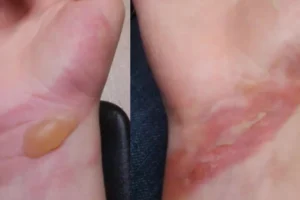 First-degree burn on a hand showing redness and swelling