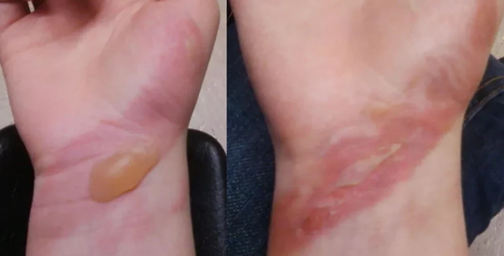 First-degree burn on a hand showing redness and swelling